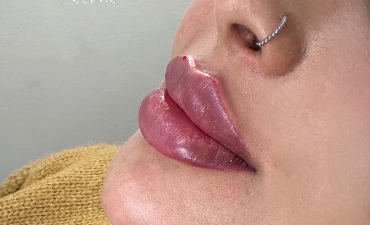 Läppar efter fillerbehandling med 1 ml hyaluronsyrafiller hos I'M Beauty Clinic