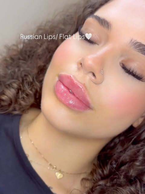 Russian lips med filler hos I'M Beauty Clinic
