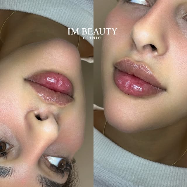 Läppfiller 1 ml, resultat
