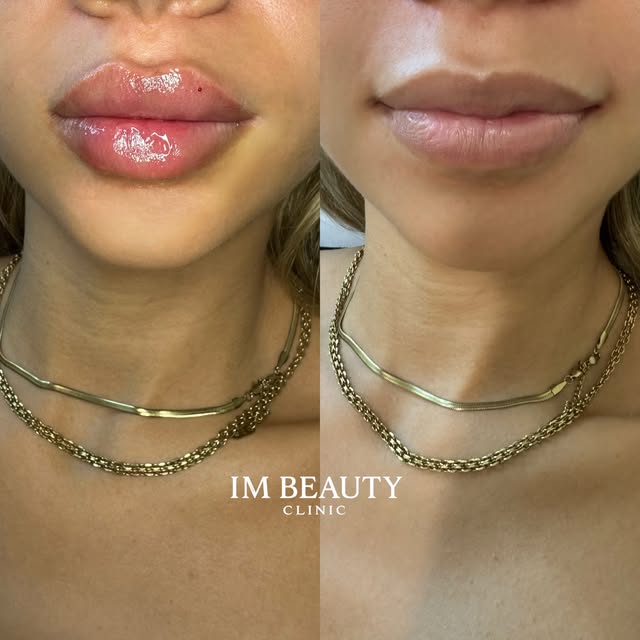 Läppfiller med naturlig volym